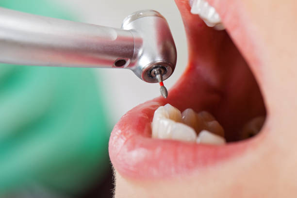 Best Emergency Tooth Extraction in Talty, TX